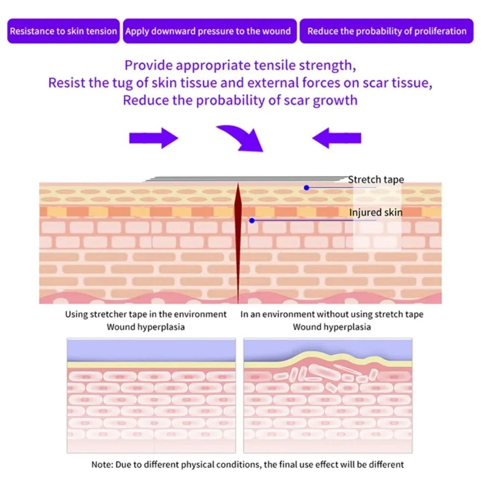 5 Strips Wound Skin Closure Strips Postpartum Wound Repair Cosmetic Surgery Strip Adhesive Medical Suture Free Surgical Tape - Cozy & Co. Market