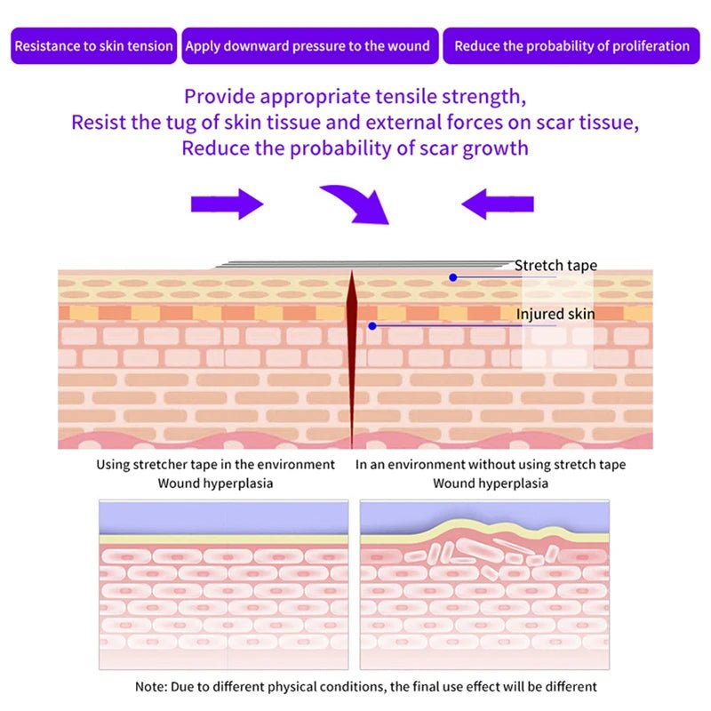 5 Strips Wound Skin Closure Strips Postpartum Wound Repair Cosmetic Surgery Strip Adhesive Medical Suture Free Surgical Tape - Cozy & Co. Market