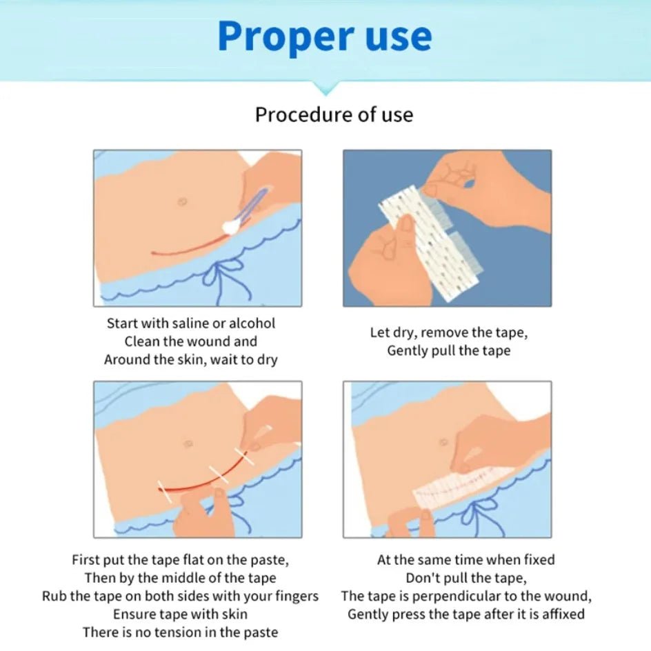 5 Strips Wound Skin Closure Strips Postpartum Wound Repair Cosmetic Surgery Strip Adhesive Medical Suture Free Surgical Tape - Cozy & Co. Market