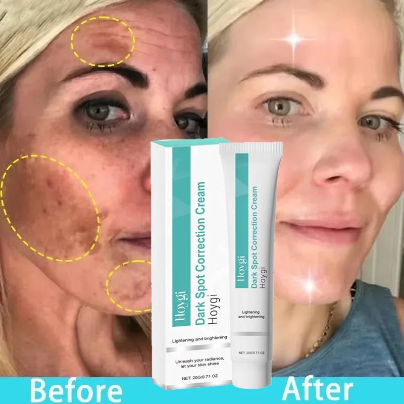 Powerful Spot-removing Whitening Freckles Cream Remove Melasma Dark Spots Fade Pigmentation Acne Moisturizing Brighten Skin Care - Cozy & Co. Market