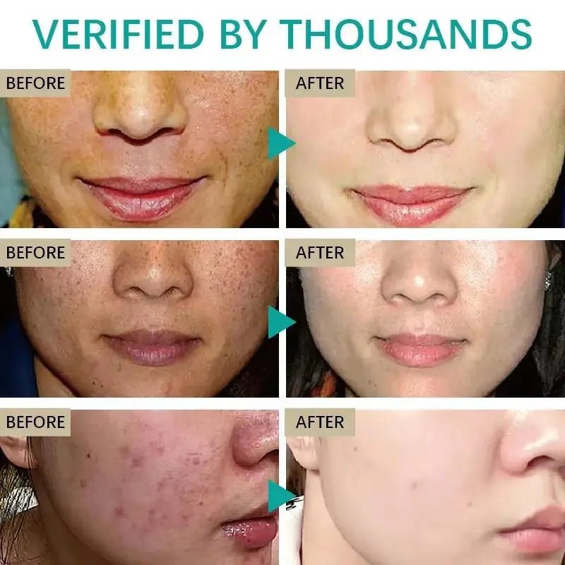 Powerful Spot-removing Whitening Freckles Cream Remove Melasma Dark Spots Fade Pigmentation Acne Moisturizing Brighten Skin Care - Cozy & Co. Market