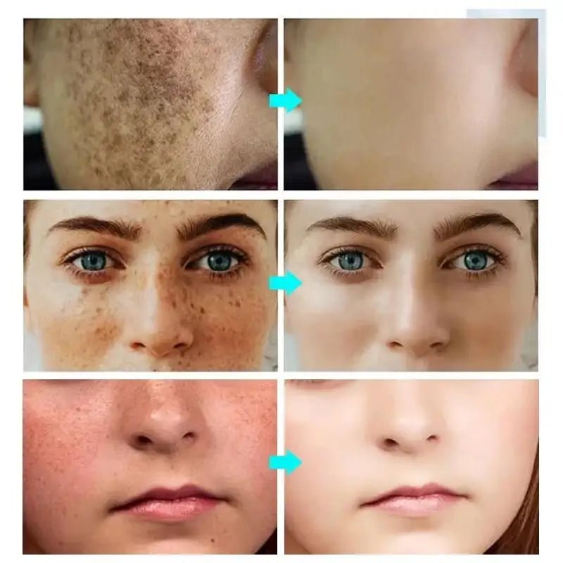 Powerful Spot-removing Whitening Freckles Cream Remove Melasma Dark Spots Fade Pigmentation Acne Moisturizing Brighten Skin Care - Cozy & Co. Market