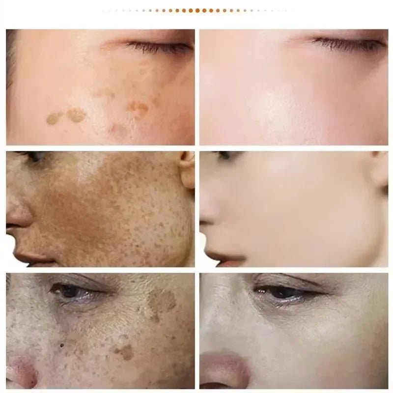 Powerful Spot-removing Whitening Freckles Cream Remove Melasma Dark Spots Fade Pigmentation Acne Moisturizing Brighten Skin Care - Cozy & Co. Market