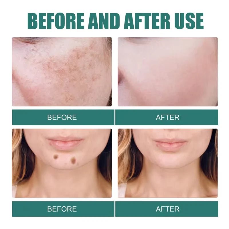 Powerful Spot-removing Whitening Freckles Cream Remove Melasma Dark Spots Fade Pigmentation Acne Moisturizing Brighten Skin Care - Cozy & Co. Market