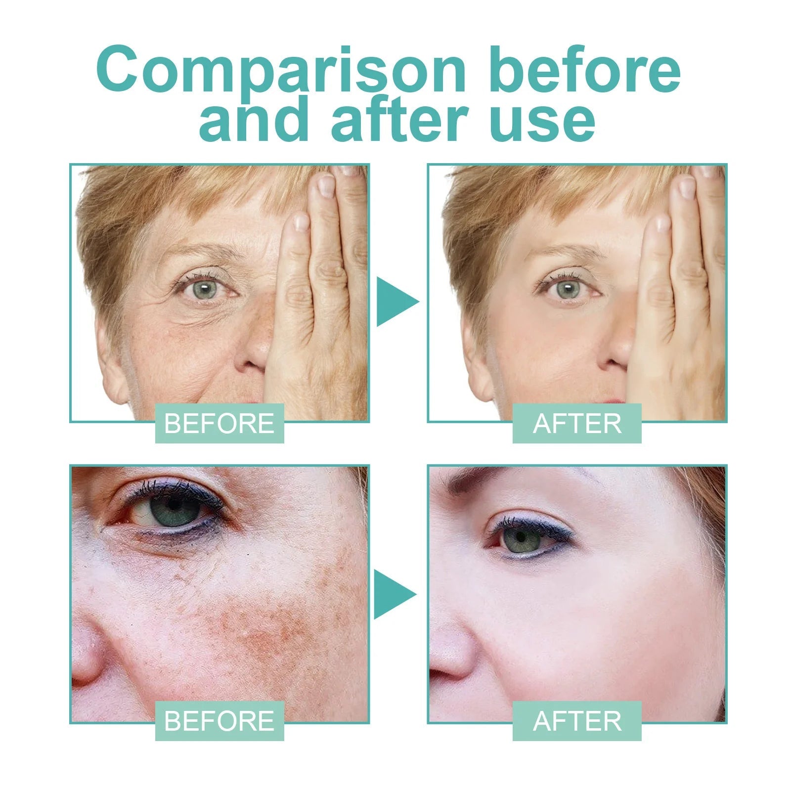 Powerful Spot-removing Whitening Freckles Cream Remove Melasma Dark Spots Fade Pigmentation Acne Moisturizing Brighten Skin Care - Cozy & Co. Market