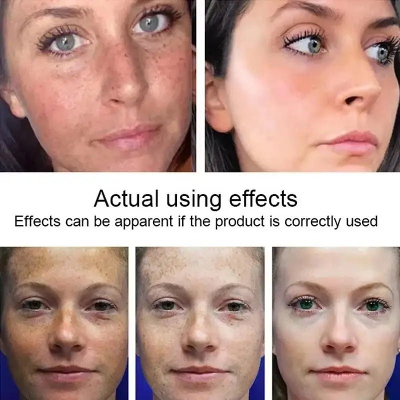 Powerful Spot-removing Whitening Freckles Cream Remove Melasma Dark Spots Fade Pigmentation Acne Moisturizing Brighten Skin Care - Cozy & Co. Market