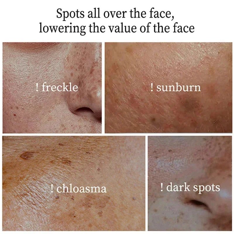Powerful Spot-removing Whitening Freckles Cream Remove Melasma Dark Spots Fade Pigmentation Acne Moisturizing Brighten Skin Care - Cozy & Co. Market