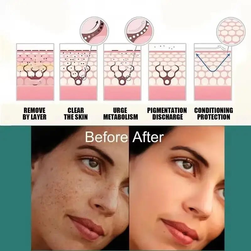 Powerful Spot-removing Whitening Freckles Cream Remove Melasma Dark Spots Fade Pigmentation Acne Moisturizing Brighten Skin Care - Cozy & Co. Market