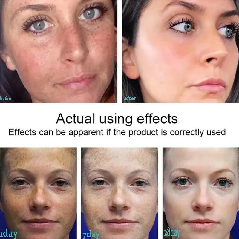 Powerful Spot-removing Whitening Freckles Cream Remove Melasma Dark Spots Fade Pigmentation Acne Moisturizing Brighten Skin Care - Cozy & Co. Market